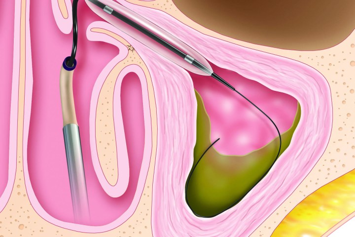 Acclarent Balloon Sinuplasty